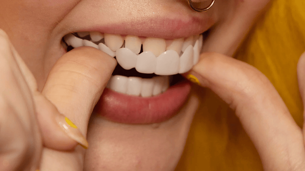Faccetta estetica rimovibile per il sorriso - faccette cosmetiche dall’aspetto naturale per spazi, discromie e denti mancanti
