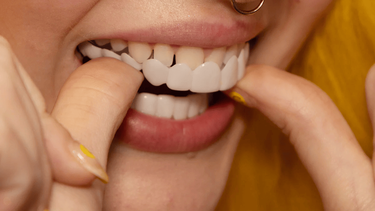 Faccetta estetica rimovibile per il sorriso - faccette cosmetiche dall’aspetto naturale per spazi, discromie e denti mancanti