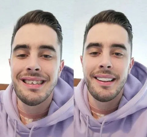 Juego completo de carillas On Smile — Incluye maxilar superior e inferior