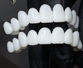 Prothèse blanche ajustable Smile Lens – Dispositif de correction directe du sourire