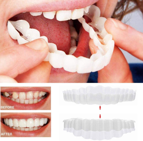 Juego completo de carillas On Smile — Incluye maxilar superior e inferior