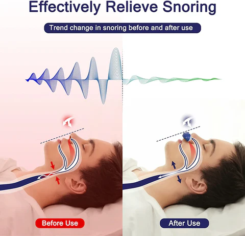 Micro-CPAP-apparaat voor slaapapneu - draagbaar alternatief voor traditionele CPAP-apparaten