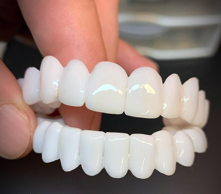 Prothèse blanche ajustable Smile Lens – Dispositif de correction directe du sourire