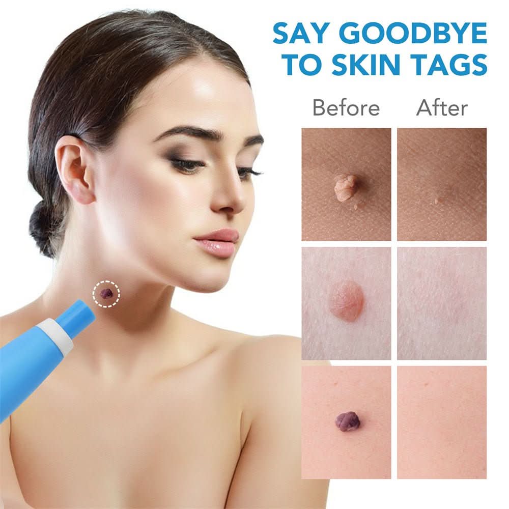 Painless Wart and Skin Tag Remover — Blood Restriction Method, 1 to 2 Weeks