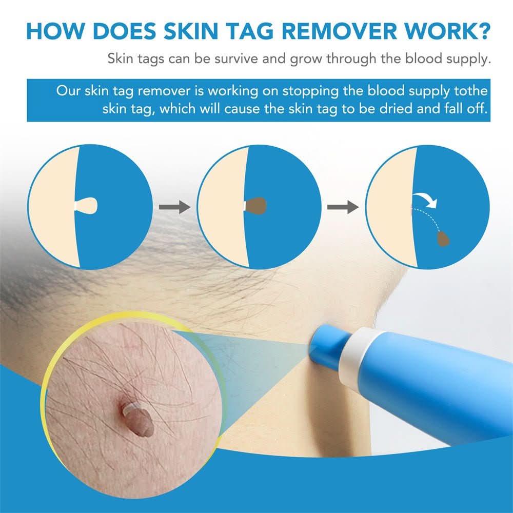Painless Wart and Skin Tag Remover — Blood Restriction Method, 1 to 2 Weeks