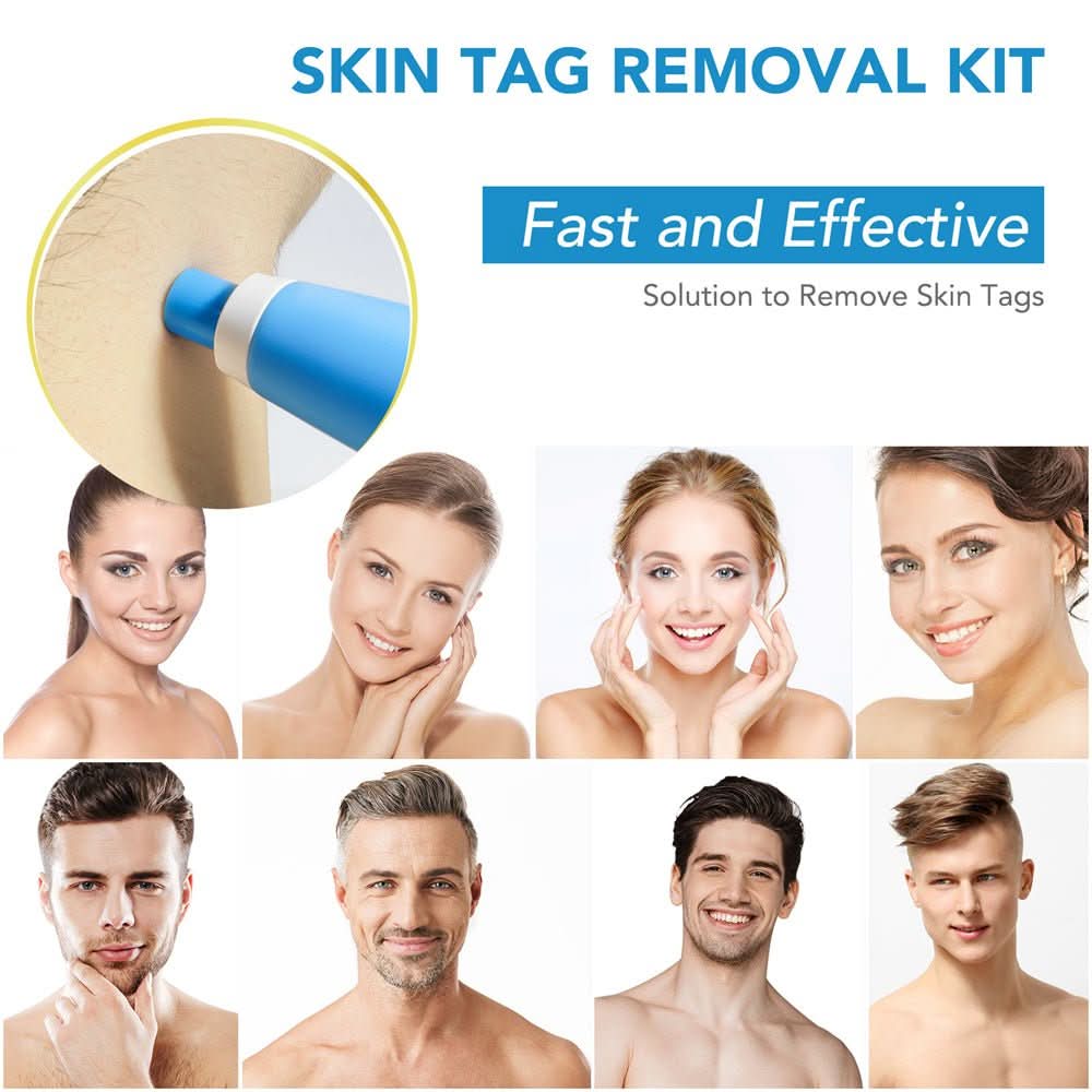 Painless Wart and Skin Tag Remover — Blood Restriction Method, 1 to 2 Weeks