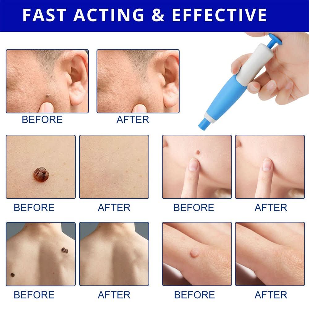 Painless Wart and Skin Tag Remover — Blood Restriction Method, 1 to 2 Weeks