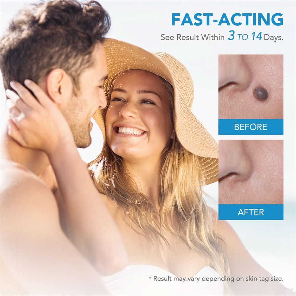 Painless Wart and Skin Tag Remover — Blood Restriction Method, 1 to 2 Weeks