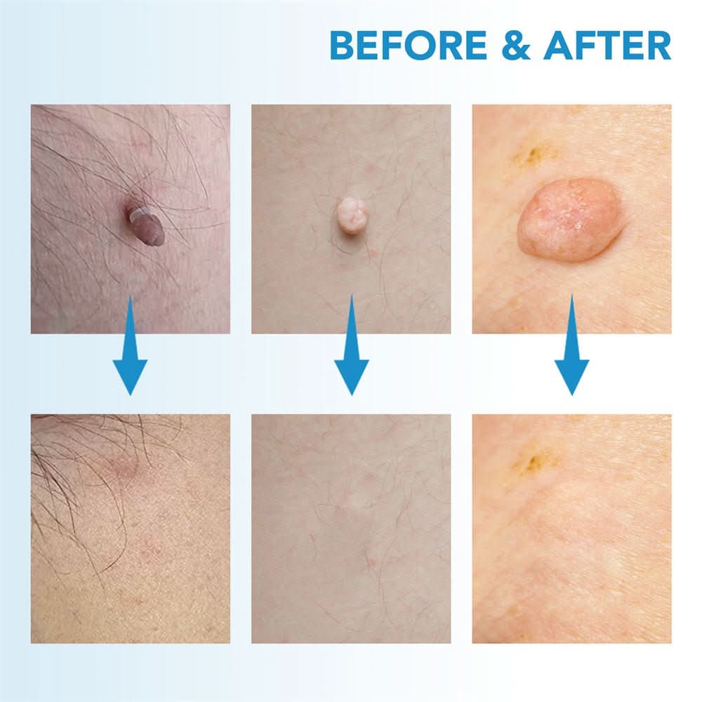Painless Wart and Skin Tag Remover — Blood Restriction Method, 1 to 2 Weeks