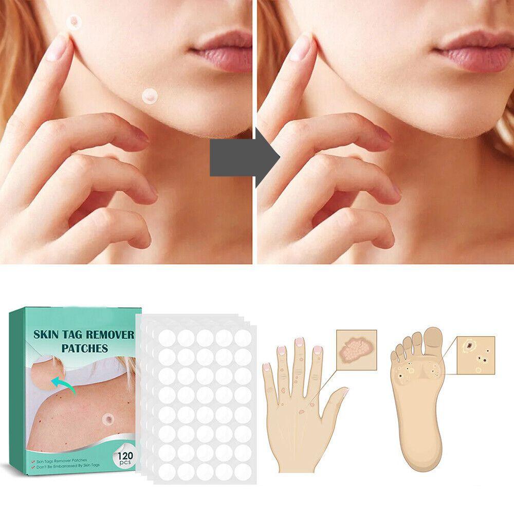 Patch adesivi SkinClear — Trattamento mirato per macchie, verruche e fibromi penduli